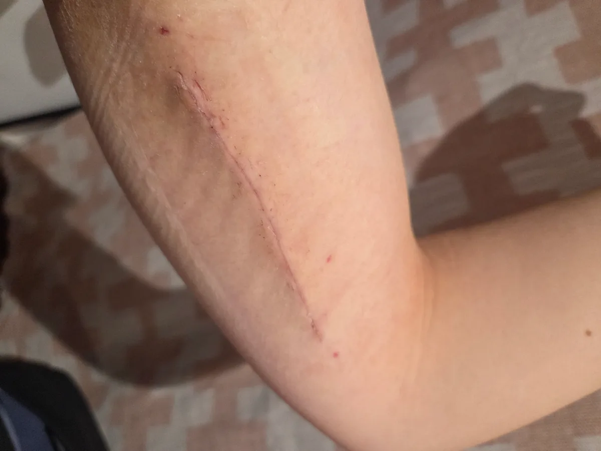 Arm after the sutures were removed after median nerve surgery