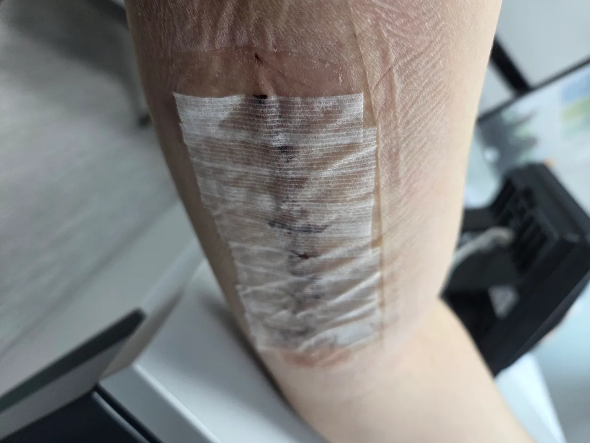 Arm before the sutures were removed after median nerve surgery